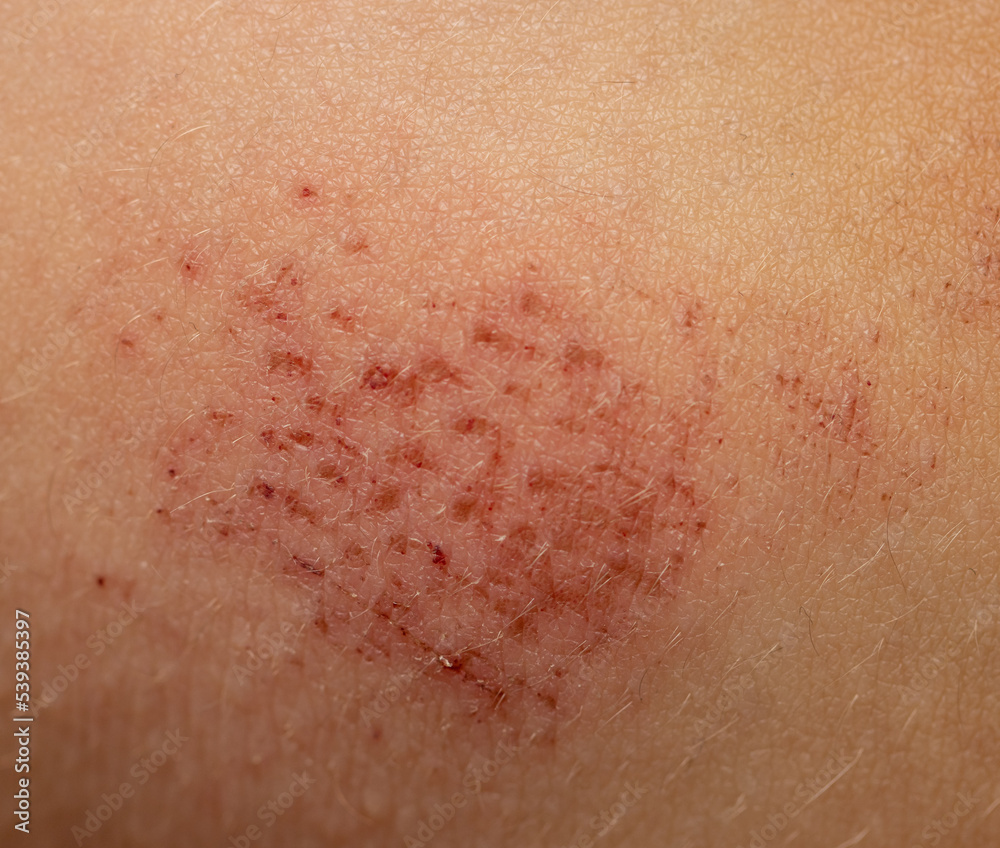 scratches on the skin as a background scratches on the skin as a background