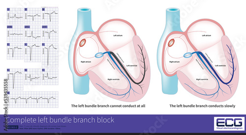 In complete left bundle branch block, the conduction of the LBB can be completely interrupted or can still be conducted, but it is delayed by at least 45ms than the RBB. photo