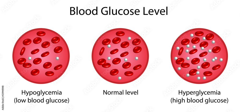 Blood Glucose Levels Normal Level Hypoglycemia low Blood Sugar blood-glucose-levels-normal-level-hypoglycemia-low-blood-sugar