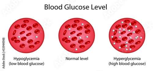 Blood Glucose Levels. Normal level, hypoglycemia (low blood sugar), hyperglycemia (high blood sugar), sugar test. vector diagram photo