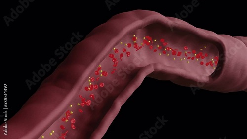 Closeup Cholesterol Buildup in Blood Vessel (cross-section) - AlphaBG photo