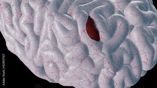 Brain Hemorrhage - With Alpha Channel photo