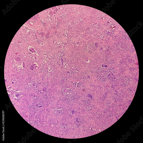 Finger(biopsy): Photomicrograph of giant cell tumor, microscopic show neoplasm of numerous osteoclast like giant cells, spindle and round to oval mononuclear cells present. photo