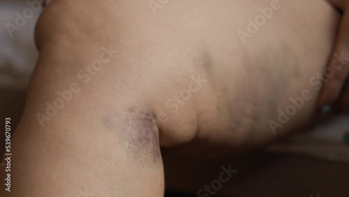 big bruises on a thick female leg photo