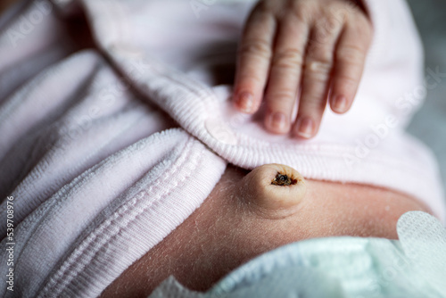 Newborn hand and navel with umbilical cord just fallen off, umbilical hernia in infants photo