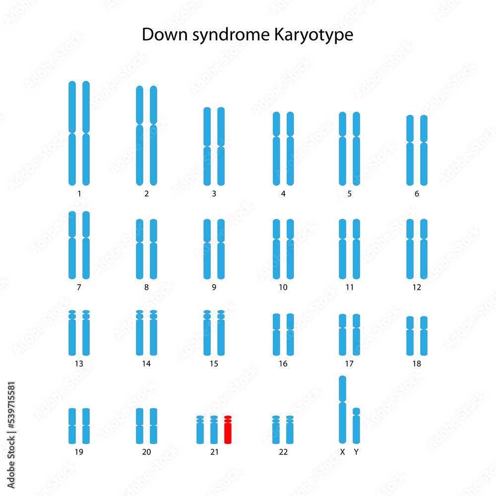 Down syndrome (trisomy 21) human karyotype Stock Illustration Adobe Stock