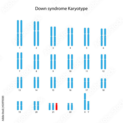 Down syndrome  trisomy 21  human karyotype 