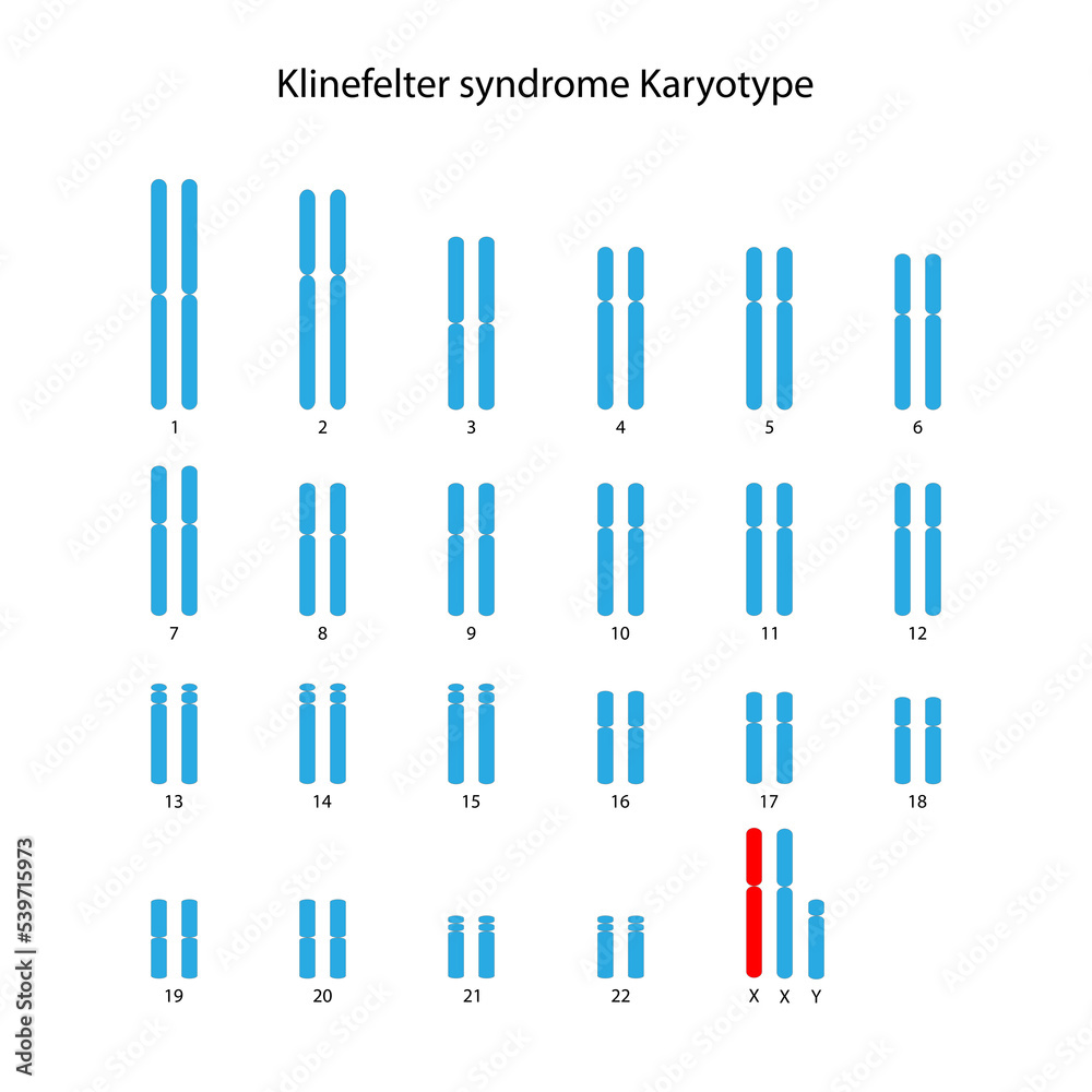 Klinefelter syndrome (XXY) human karyotype Stock Illustration | Adobe Stock