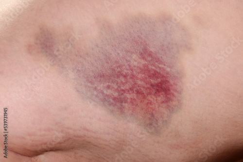 a large bruise on a person's leg. haematoma photo