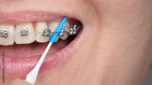 A woman uses a dental brush to clean the braces on her teeth. Braces on the teeth. The concept of bite correction, treatment and orthodontics. photo