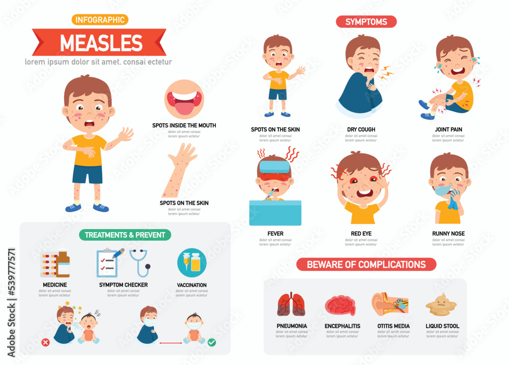 Measles infographic with children boy characters representing symptoms vector illustration - obrazy, fototapety, plakaty 