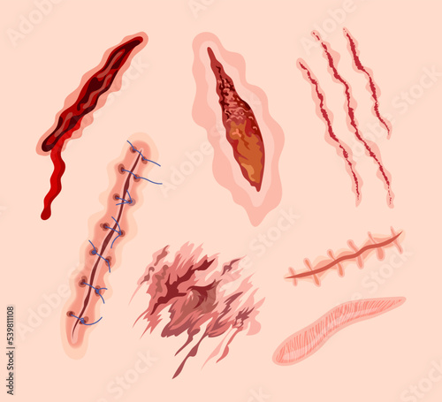 Skin scars with stitches cartoon illustration set. Bloody wound, injures, scratches, bruises, surgical sutures on legs or arms. Skin cuts or hurt after operation. Health, medicine concept