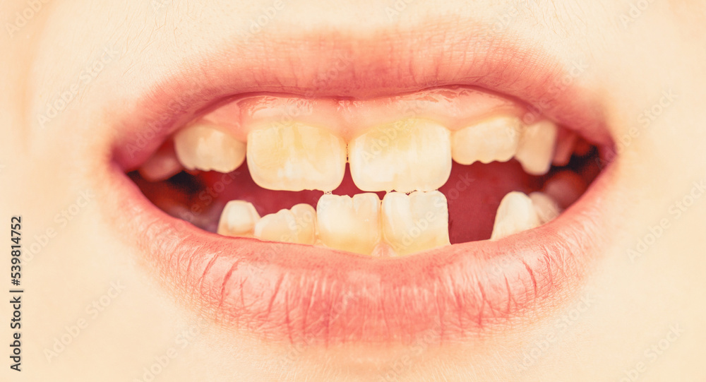 Child smile and show her crowding tooth. Close up of unhealthy baby teeths. Kid patient open mouth showing cavities teeth decay Child smile and show her crowding tooth. Close up of unhealthy baby teeths. Kid patient open mouth showing cavities teeth decay