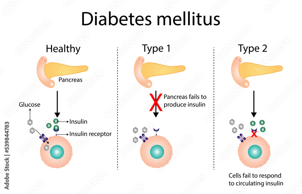Diabetes mellitus type 1, pancreas's failure to produce enough insulin  and type 2, cells fail to respond to insulin (Insulin resistance). Result in high blood glucose levels. Vector illustration
