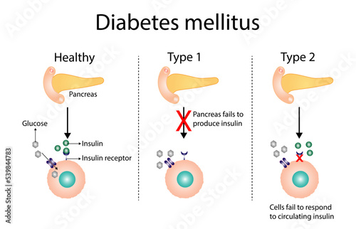 Diabetes mellitus type 1, pancreas's failure to produce enough insulin and type 2, cells fail to respond to insulin (Insulin resistance). Result in high blood glucose levels. Vector illustration 