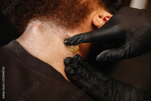 Sugaring master removes beard hair to a white man with sugar paste