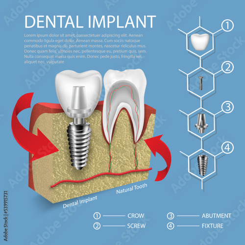 Human teeth and dental implant vector in gum mockup.