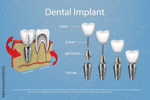 Human teeth and dental implant vector in gum mockup.