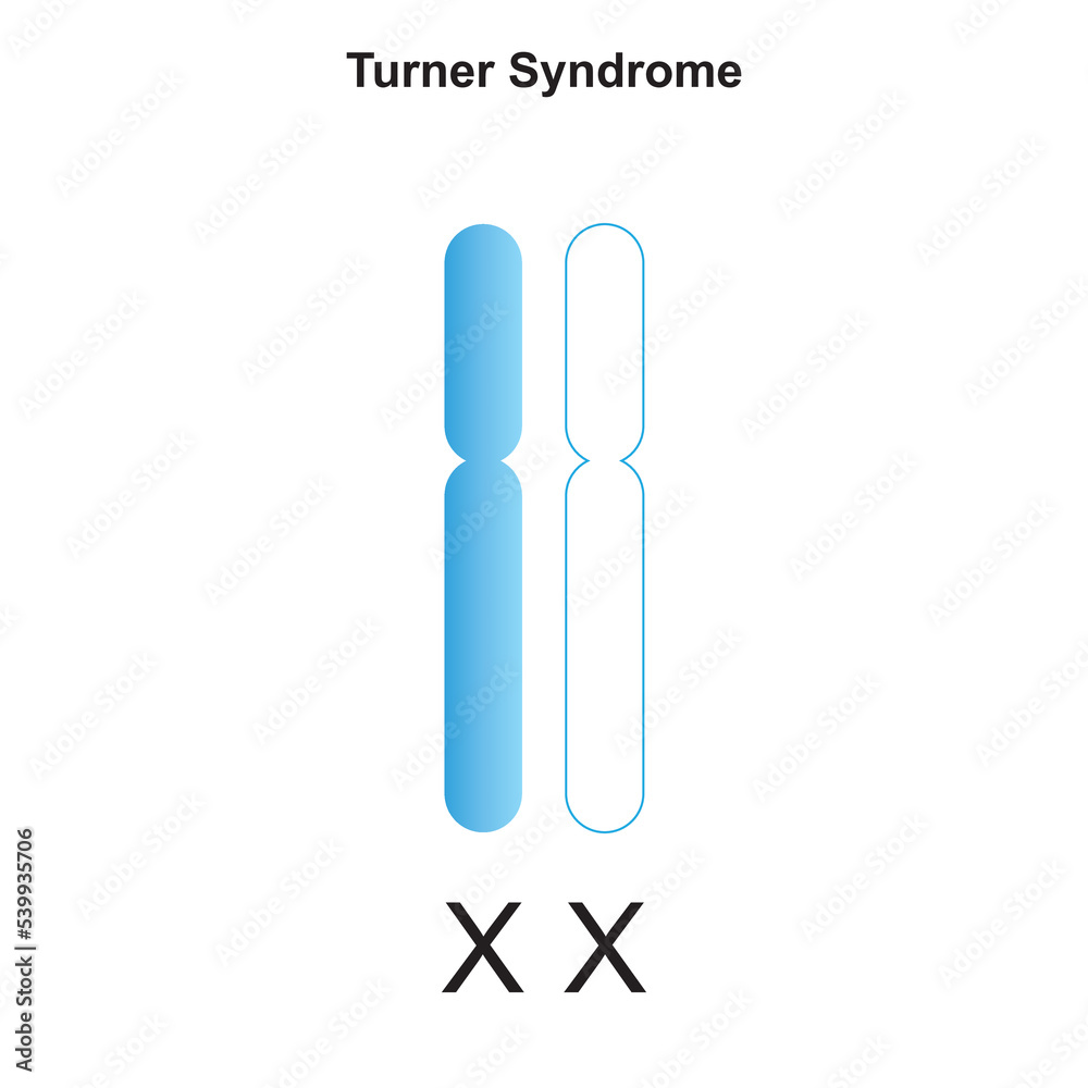 Vetor de Scientific Designing of Turner Syndrome (Monosomy X). Colorful