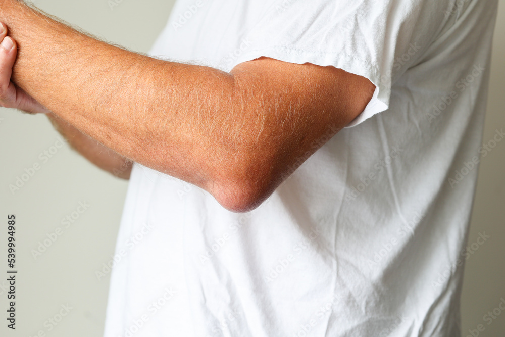 Man swelling erythematous lump pain elbow from Olecranon bursitis