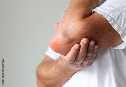 Canvas Print Man swelling erythematous lump pain elbow from Olecranon bursitis, student elbow medical condition