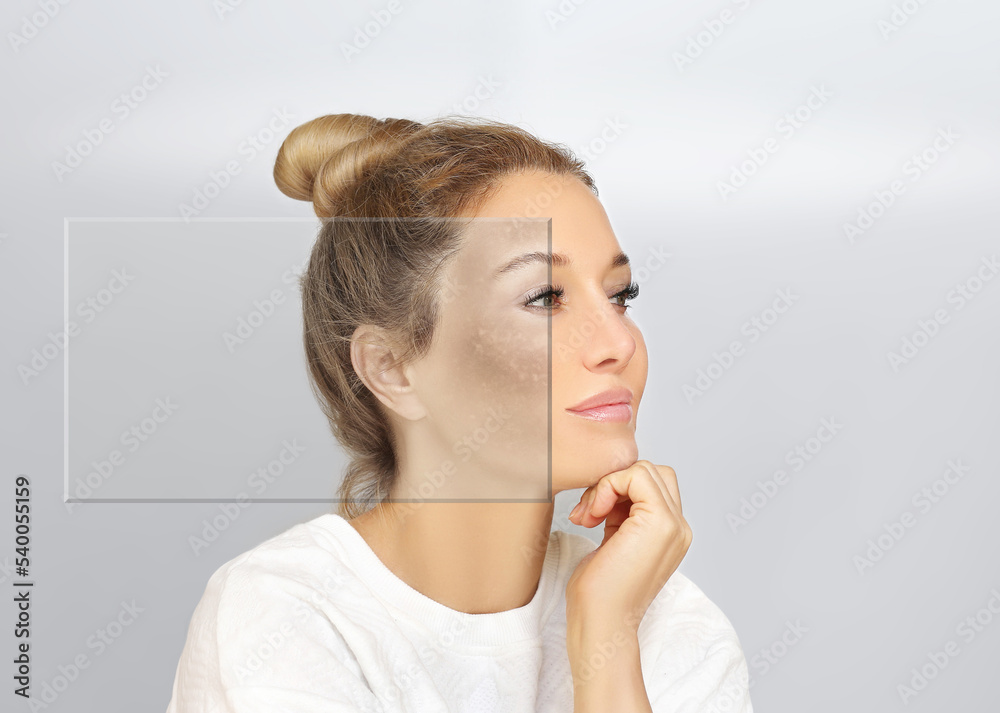 Dark spots, freckles,hyperpigmentation(melasma or chloasma),concept - skin lightening, skin whitening, fruit acids,AHA, Skin Brightening Dark spots, freckles,hyperpigmentation(melasma or chloasma),concept - skin lightening, skin whitening, fruit acids,AHA, Skin Brightening