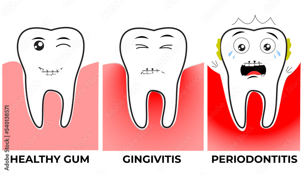 tooth-characters-stages-of-tooth-decay-stock-vector-adobe-stock