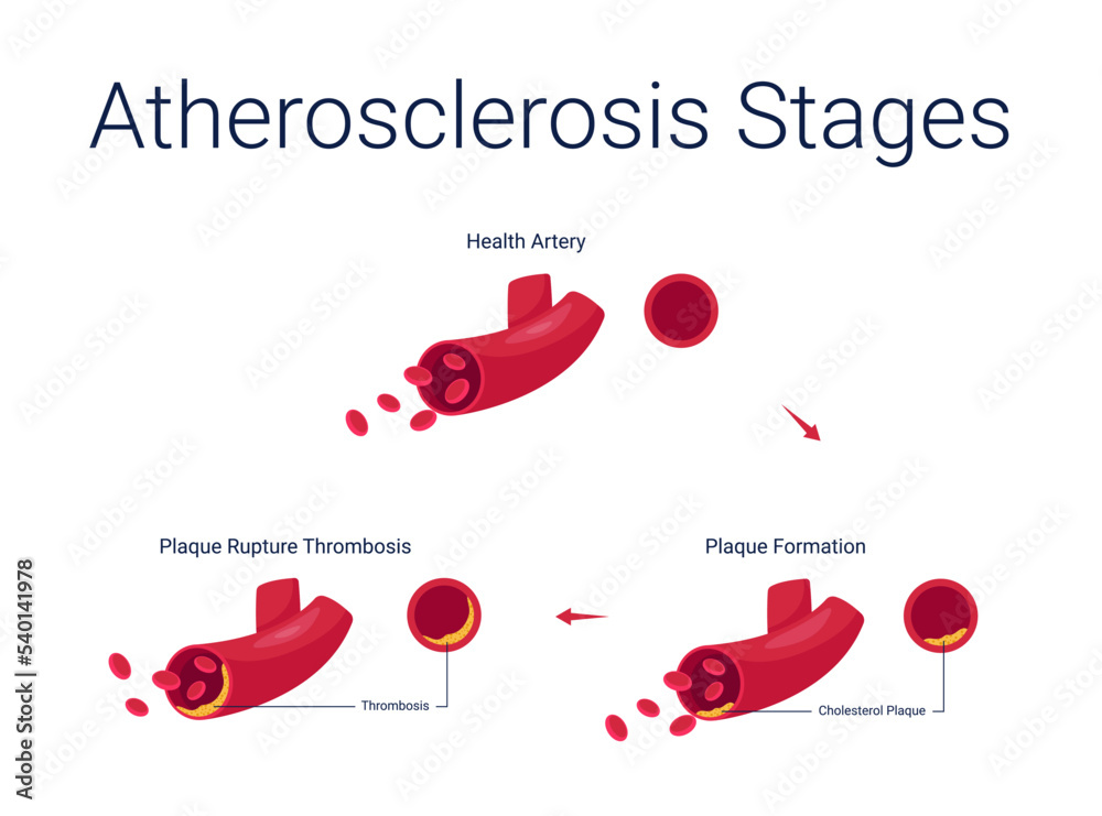Atherosclerosis Diseases Stage Anatomy Diagram Vector Illustration