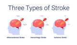 Ischemic stroke diseases stage anatomy diagram vector illustration