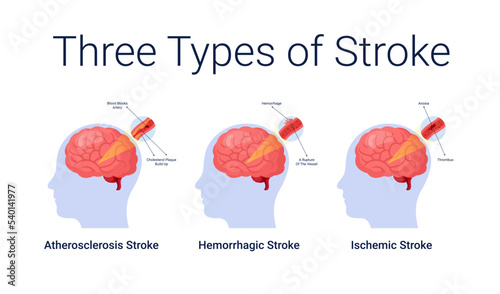 Ischemic stroke diseases stage anatomy diagram vector illustration photo
