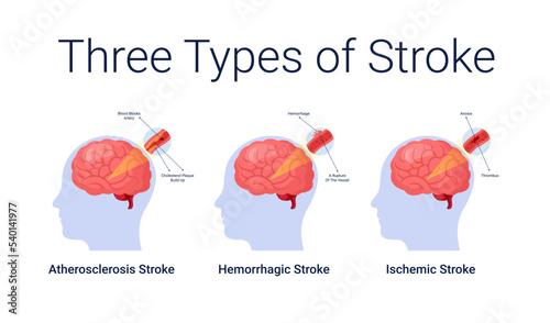 Ischemic stroke diseases stage anatomy diagram vector illustration