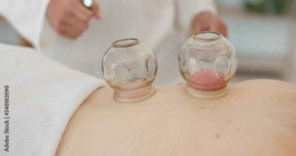 Relax, cupping treatment and back massage at a wellness, healing and beauty spa at resort. Calm, therapy and self care with glass cup vacuum routine by therapist at health, luxury and cosmetic salon. Relax, cupping treatment and back massage at a wellness, healing and beauty spa at resort. Calm, therapy and self care with glass cup vacuum routine by therapist at health, luxury and cosmetic salon.