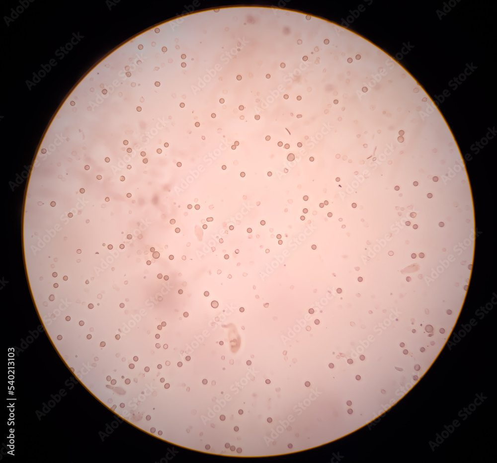Abnormal result of urinalysis examination from microscopic method under