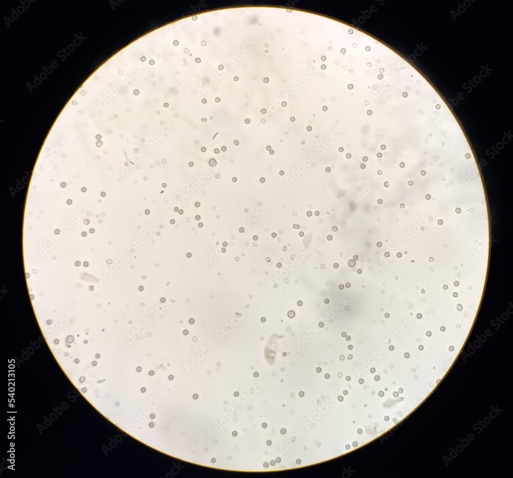 abnormal-result-of-urinalysis-examination-from-microscopic-method-under