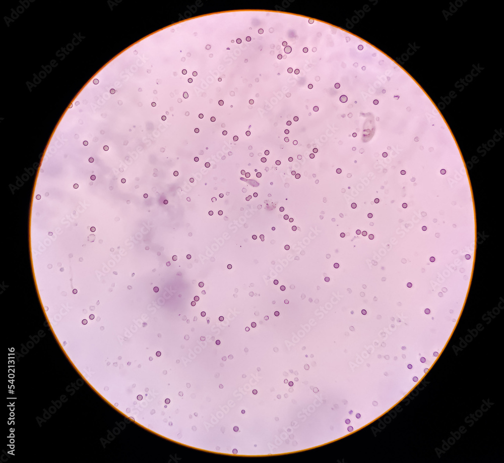 Abnormal result of urinalysis examination from microscopic method under