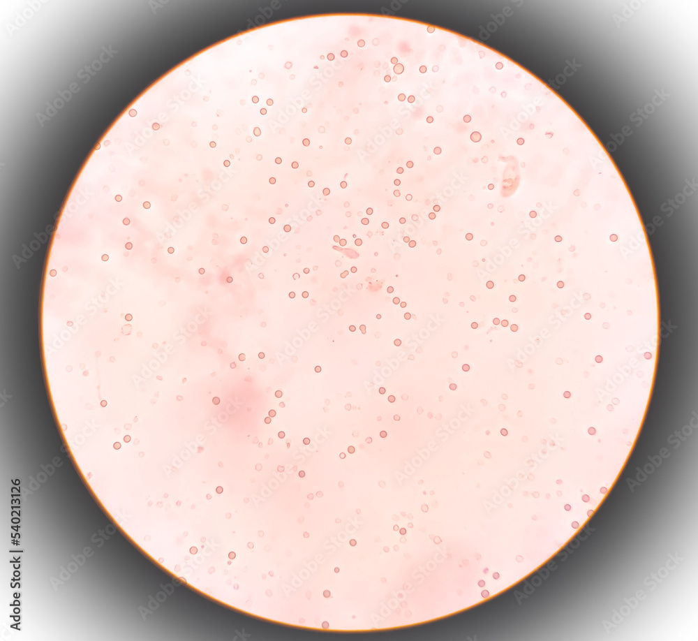 Abnormal result of urinalysis examination from microscopic method under