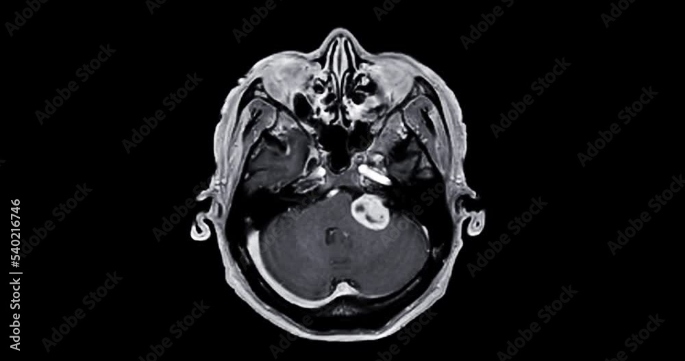 MRI Brain can help doctors look for conditions such as bleeding, swelling, tumors, infections