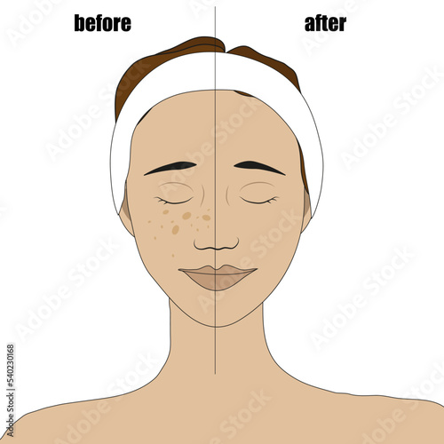 The face of a girl with a bandage on her hair with freckles before and after bleaching freckles and age spots