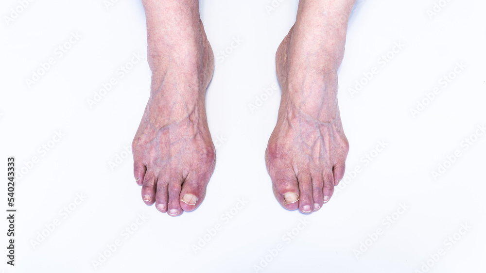 Bunion or hallux valgus on senior woman foot. Deformity of the joint