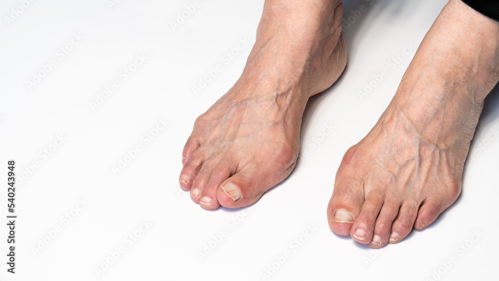 Bunion or hallux valgus on senior woman foot. Deformity of the joint connecting the big toe to the foot. Skeletal disorder on old woman body Bunion or hallux valgus on senior woman foot. Deformity of the joint connecting the big toe to the foot. Skeletal disorder on old woman body