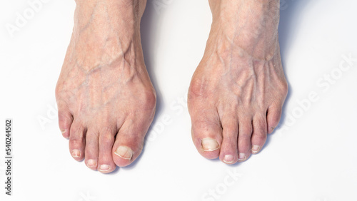 Bunion or hallux valgus on senior woman foot. Deformity of the joint connecting the big toe to the foot. Skeletal disorder on old woman body photo