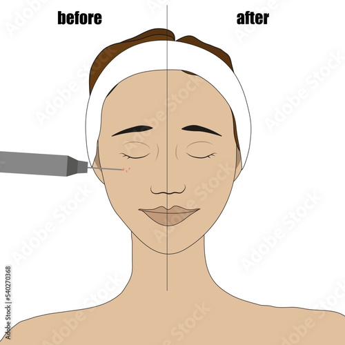 A girl's face with a bandage on her hair, with vascular asterisks on her cheeks and removing them
