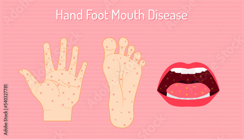 Vector of hand, foot and mouth disease against a pink background