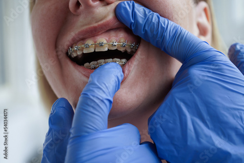 The doctor is examining a female patient with braces. The problem of plaque on teeth during orthodontic treatment. photo