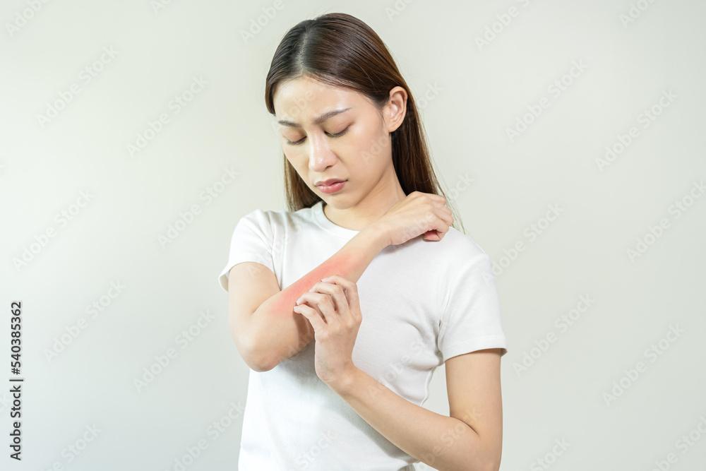 Dermatology asian young woman, girl allergy, allergic reaction from atopic, insect bites on her arm, hand in scratching itchy, itch red spot or rash of skin. Healthcare, treatment of beauty. Dermatology asian young woman, girl allergy, allergic reaction from atopic, insect bites on her arm, hand in scratching itchy, itch red spot or rash of skin. Healthcare, treatment of beauty.