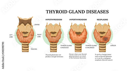 Thyroid gland diseases - hyperthyroidism, hypothyroidism and neoplasms photo