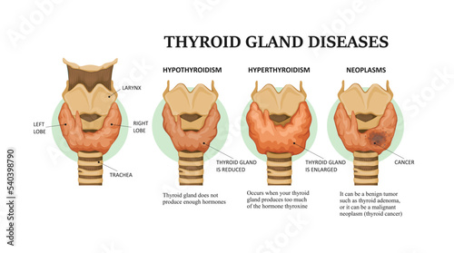 Thyroid gland diseases - hyperthyroidism, hypothyroidism and neoplasms