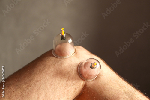 Fényképezés Cupping therapy