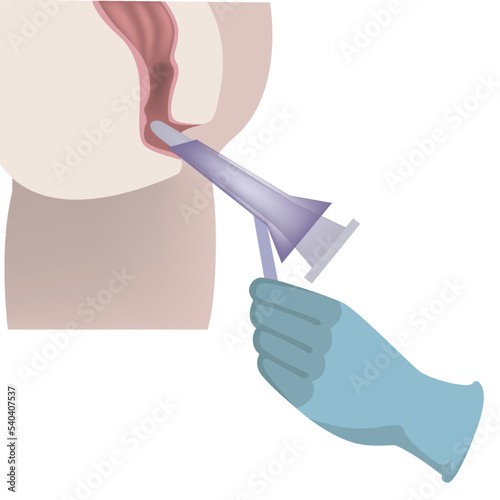 Anoscopy. Diagram with medical procedure. Vector illustration