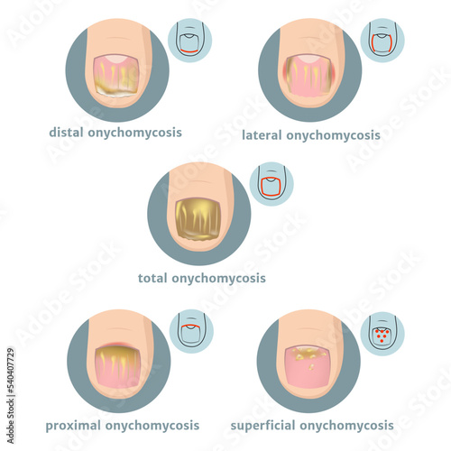 Types of onychomycosis of nails. Round icons with infographics. Vector illustration photo